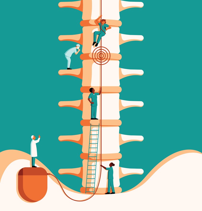 illustration of Cover illustration for Case Notes magazine focusing on spinal cord stimulation, a procedure for chronic pain that includes a minor surgery to implant electrodes in the spine. These electrodes connect to a battery pack under the skin, which blocks pain signals from reaching the brain.