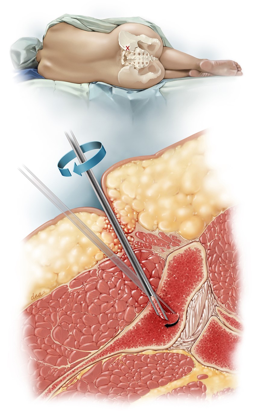 illustration of Main illustration shows marrow punch inserted into hip bone to collect biopsy sample. Inset illustration shows patient positioning. medical, patient education, anatomy, surgery, doctor, health, healthcare, realistic, scientific, editorial, digital, drapery, people, sensitive, beautiful, soft light, instructional, technology, hospital, clinical,
procedural, color,