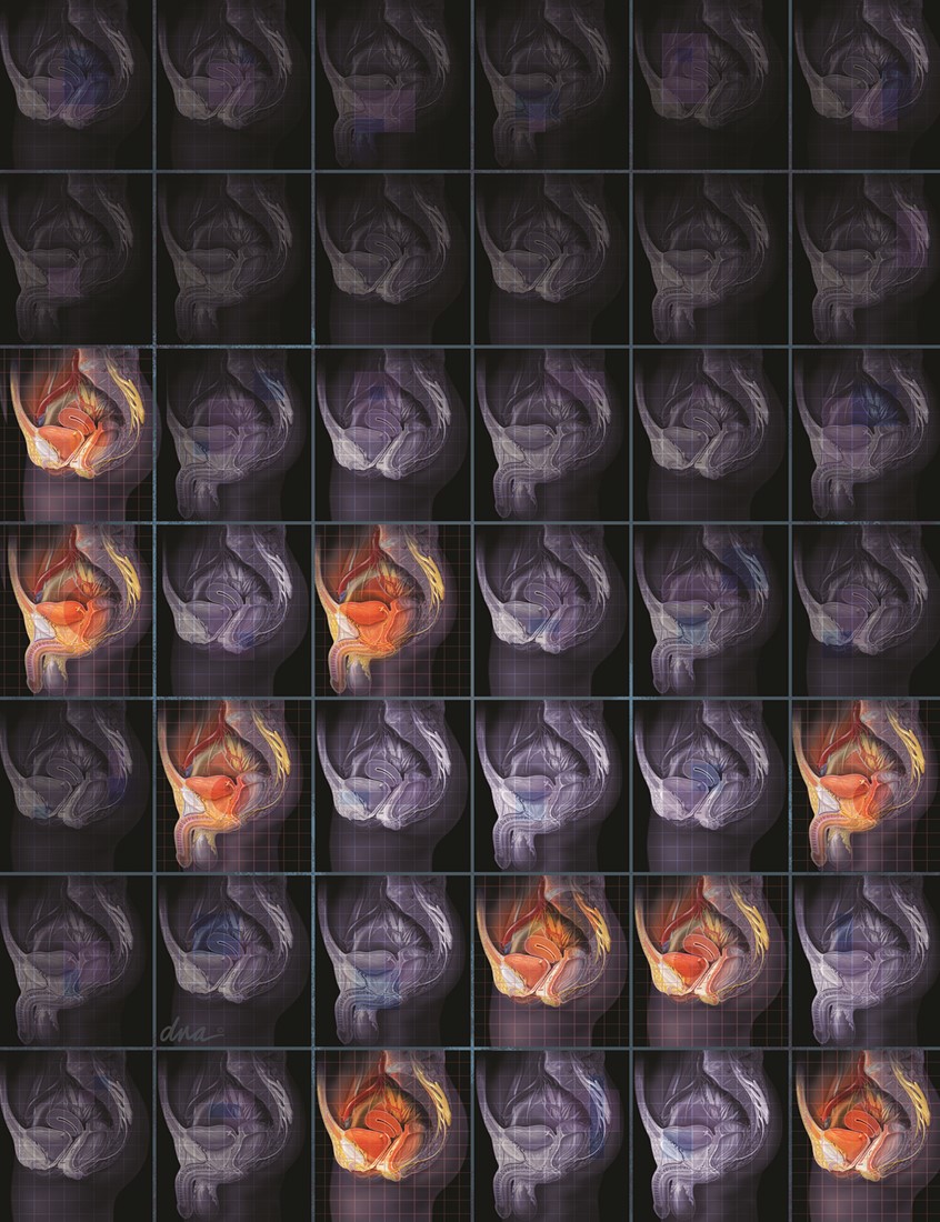 illustration of Multiple images of male and female pelvic areas highlighted to show approximate incidence of chronic pelvic pain. medical, patient education, anatomy, healthcare, gynecology, urology, pain, clinician, health, clinical scientific, editorial, realistic, graphic, dark blue, gray, repetition, graph