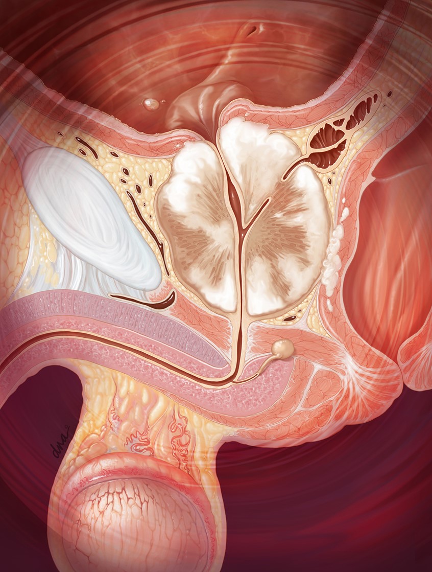 illustration of Illustration showing treatment of prostate cancer with androgen deprivation therapy. medical, cancer, doctor, healthcare, patient, anatomy, realistic, scientific, warm colors, editorial, clinical, color, beautiful, careful rendering