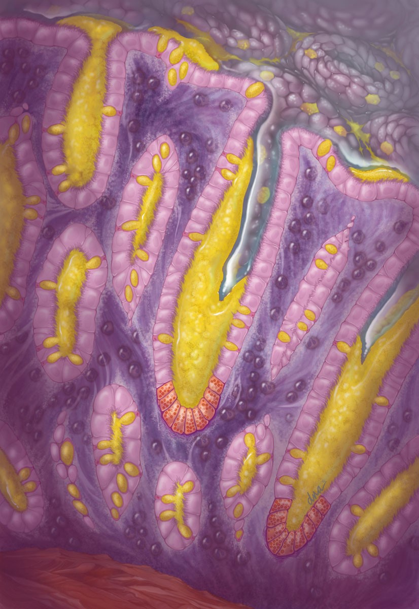 illustration of Close up view of large intestine histology showing mucositis. Normal simple columnar cells of the large intestine are misshapen and have become cuboidal. Goblet cells decrease along withe an increase of mucous secretions.