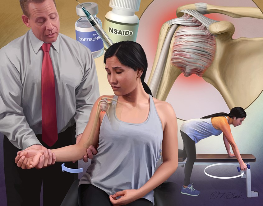 illustration of Physician doing lateral rotation test on patient’s arm to check for adhesive capsulitis. Background includes patient doing an exercise, NSAID pill bottle, cortisone injection, and inflamed shoulder joint capsule.