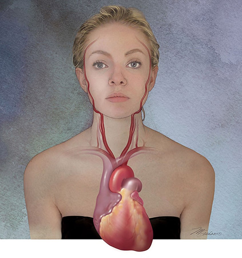 illustration of A portrait of a young woman with her heart projected to a frontal position. The heart shows the ventricles, atria, superior vena cava, aorta and the pulmonary trunk. The arteries supplying the head are seen.