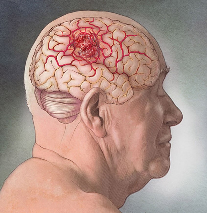 illustration of This illustration is a 3/4 view from a posterior position of an elderly man with his brain and cerebellum revealed. A glioblastoma and its vasculature are seen in the parietal lobe of the brain.