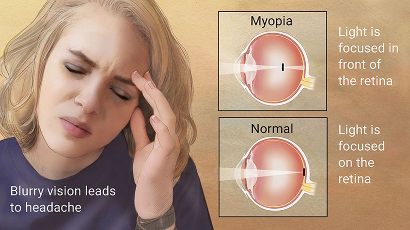 illustration of A young woman showing signs of a headache due to myopia. The right side of the illustration shows 2 cross sections of the eye; the light being focused in front of the retina in myopia compared to the light being focused on the retina in a normal eye.
