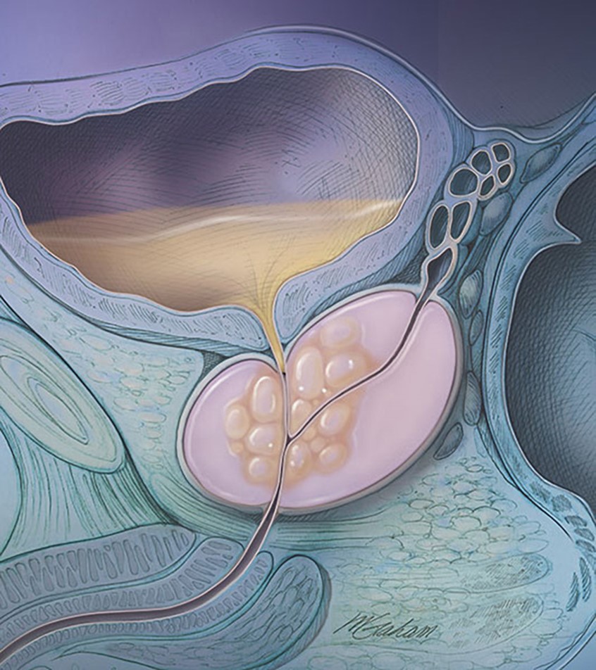 illustration of In this illustration the prostatic urethra is being compromised and the urine from the urinary bladder is unable to pass through the prostate gland. Also seen is the seminal vesicle and a portion of the rectum.