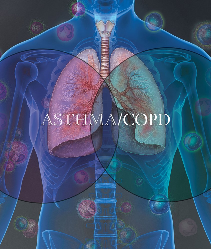 illustration of Illustration of the lungs, trachea and bronchi within the thoracic region of a torso. Two circles with the words Asthma/COPD within them are overlapping indicating the similarities of the two diseases.