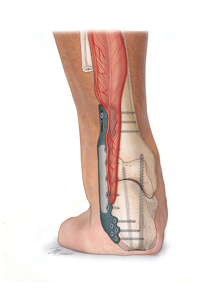 illustration of This illustration demonstrates a posterior view of a talectomy, ankle fusion and the repositioning of the FHL muscle. A titanium plate is depicted securing the fusion.