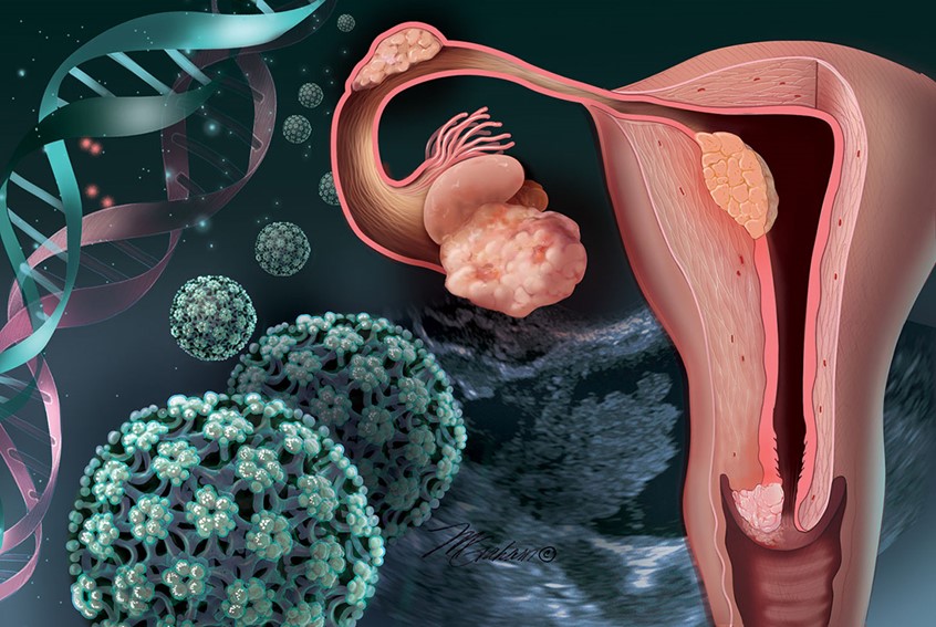 illustration of The illustration depicts the uterus showing areas of tumor growth. These areas are the cervix, the endometrium, the fallopian tube and the ovary. Human papillary virus's are shown with DNA strands indicating possible causes of these tumors. An x-ray of an ovarian tumor is show in the background.
