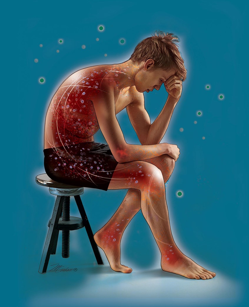 illustration of In this illustration, a young man is leaning over his knees in a thoughtful pose. A few antigens are floating around the figure causing a hypersensitivity reaction inside the body.