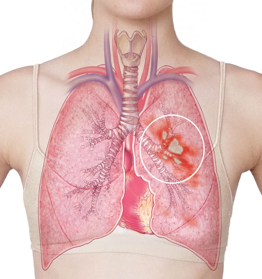 illustration of This illustration uses a photograph of a woman with illustrated lungs superimposed. The image includes the trachea, primary and secondary bronchi and lesions of lung tissue. Also seen are the subclavian and carotid vessels.