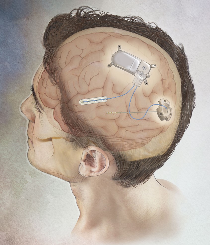 illustration of The NeuroPace Device is implanted into the skull and the leads are placed on top of the brain. it is a closed-loop brain-responsive neurostimulation device for adults with drug resistant focal epilepsy.