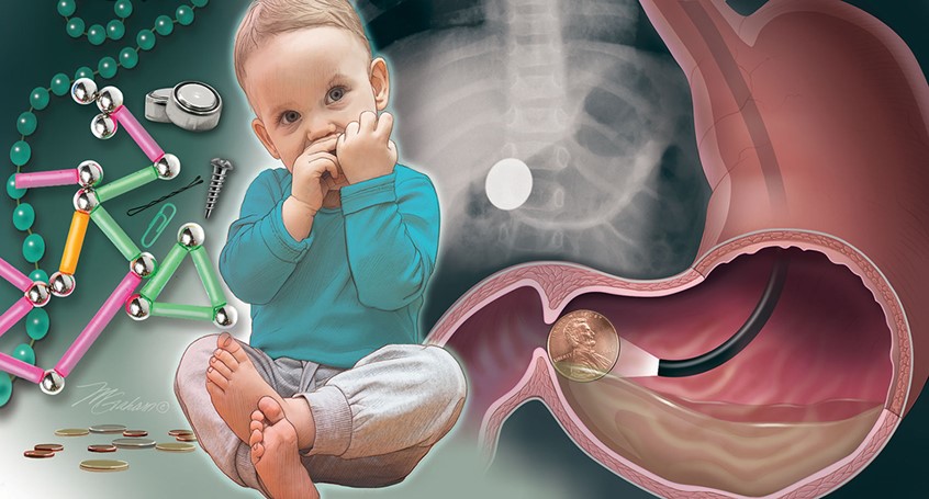 illustration of A toddler aged little boy is seen putting something in his mouth. On the left are dangerous objects that can be swallowed. The right side of the illustration depicts a stomach with an endoscope revealing a penny in the pyloric region of the stomach.