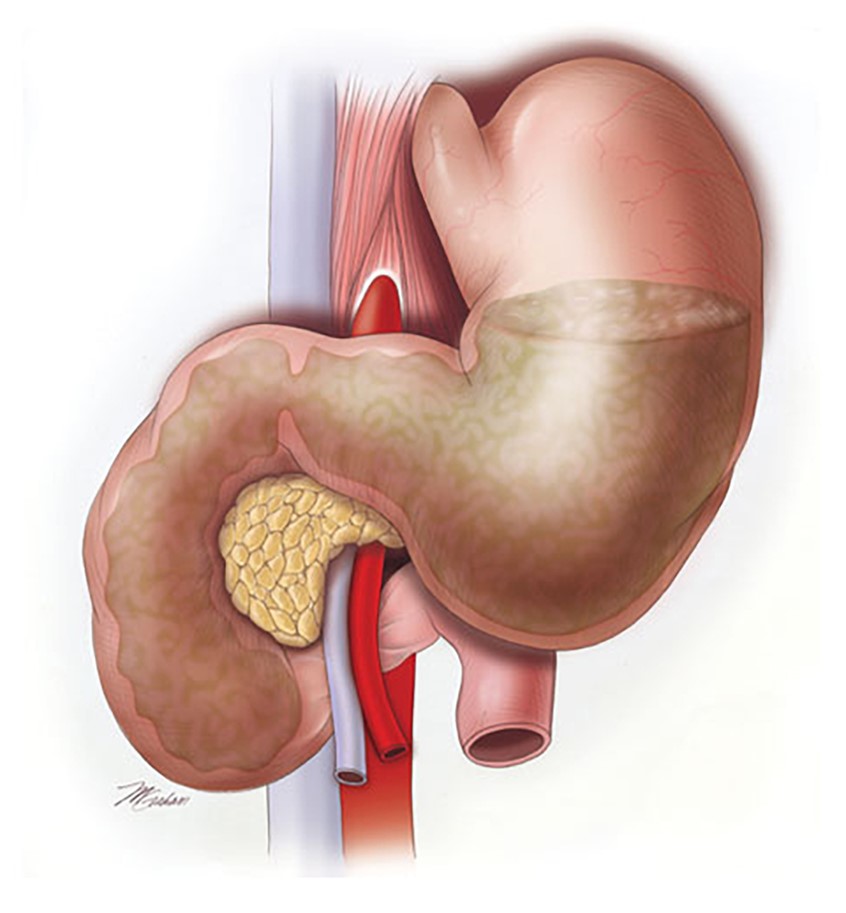illustration of SMA syndrome is a life-threatening gastro-vascular disorder where the duodenum is compressed between the abdominal aorta and the superior mesenteric artery. The illustration shows this as well as a backup of the stomach contents.