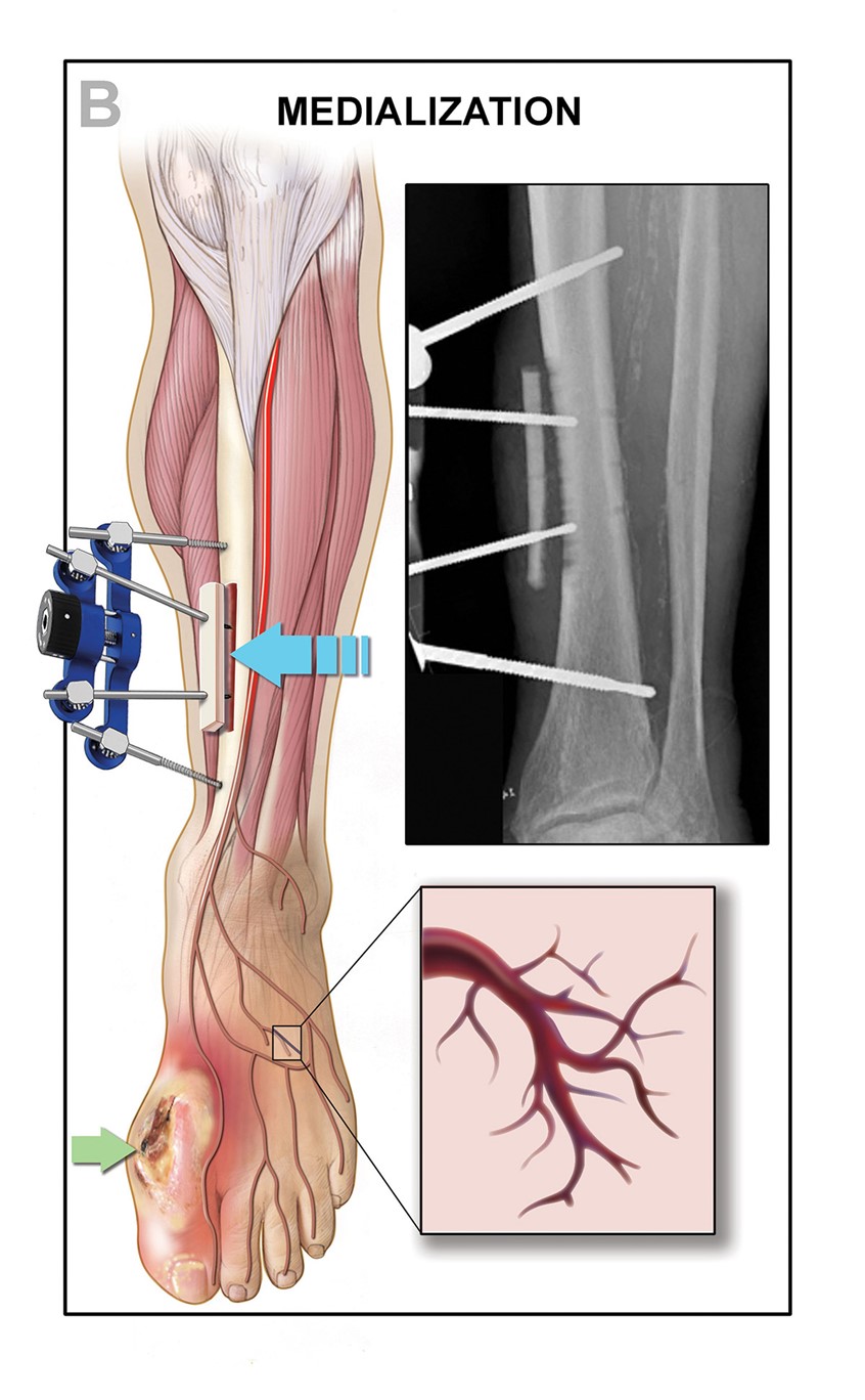 illustration of A procedure used to salvage a limb that has serious infection. The procedure promotes the proliferation of blood vessels in the region. An x-ray reveals the placement of screws and the lifted section of bone. A depiction of a deficient blood vessel is also shown in the composition.