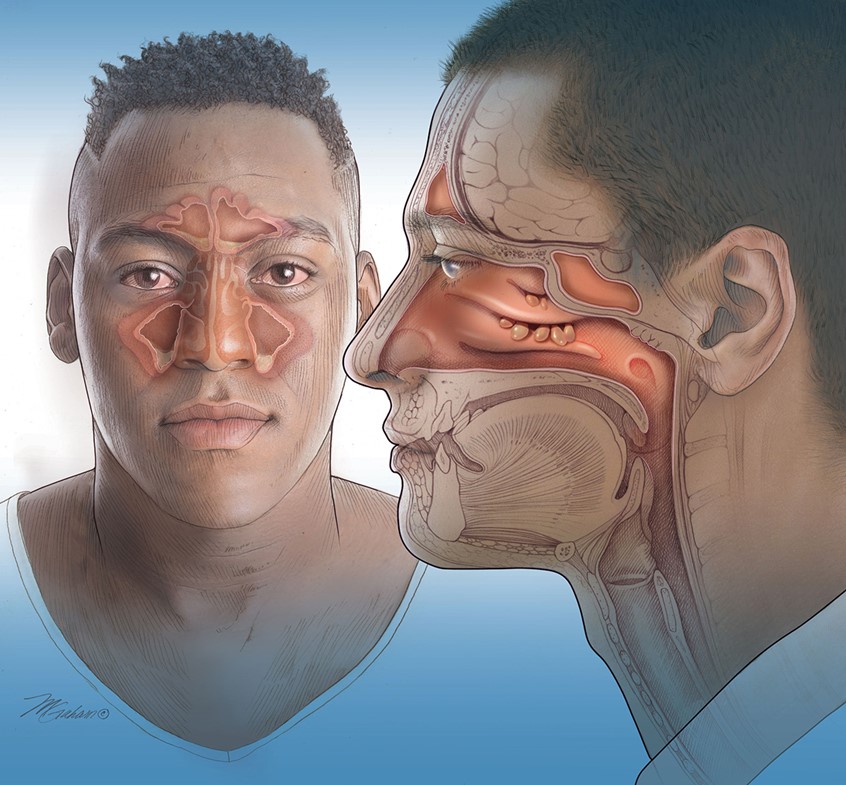 illustration of Side and frontal views of two men showing nasal polyps and a sinus infection. In the side view, the surrounding anatomy is drawn in pencil for reference.