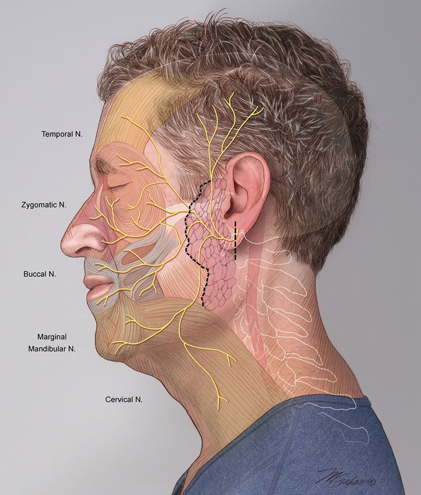 illustration of The side of a man's face showing the distribution of the facial nerve. The individual branches are labeled on the left as well as color coded within the illustration. Two dashed black lines show areas of surgical incisions. The origin of the nerve, the pons, is also shown behind the ear.