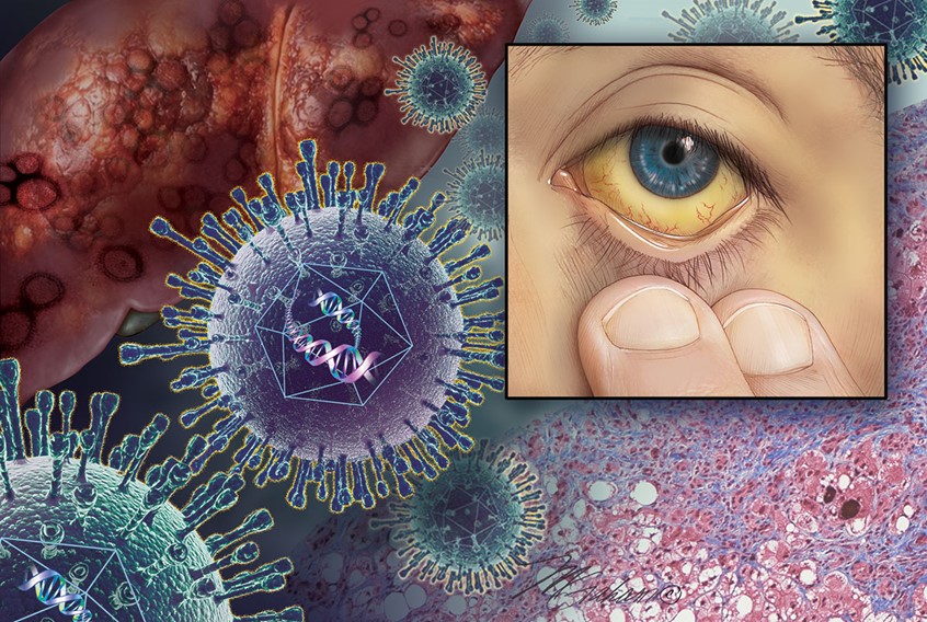 illustration of The focus of this illustration is a jaundice eye. In the upper left is a diseased liver and the lower right has a histology section of fatty liver disease. Cascading at a diagonal through the composition are images of the hepatitis C viruses.