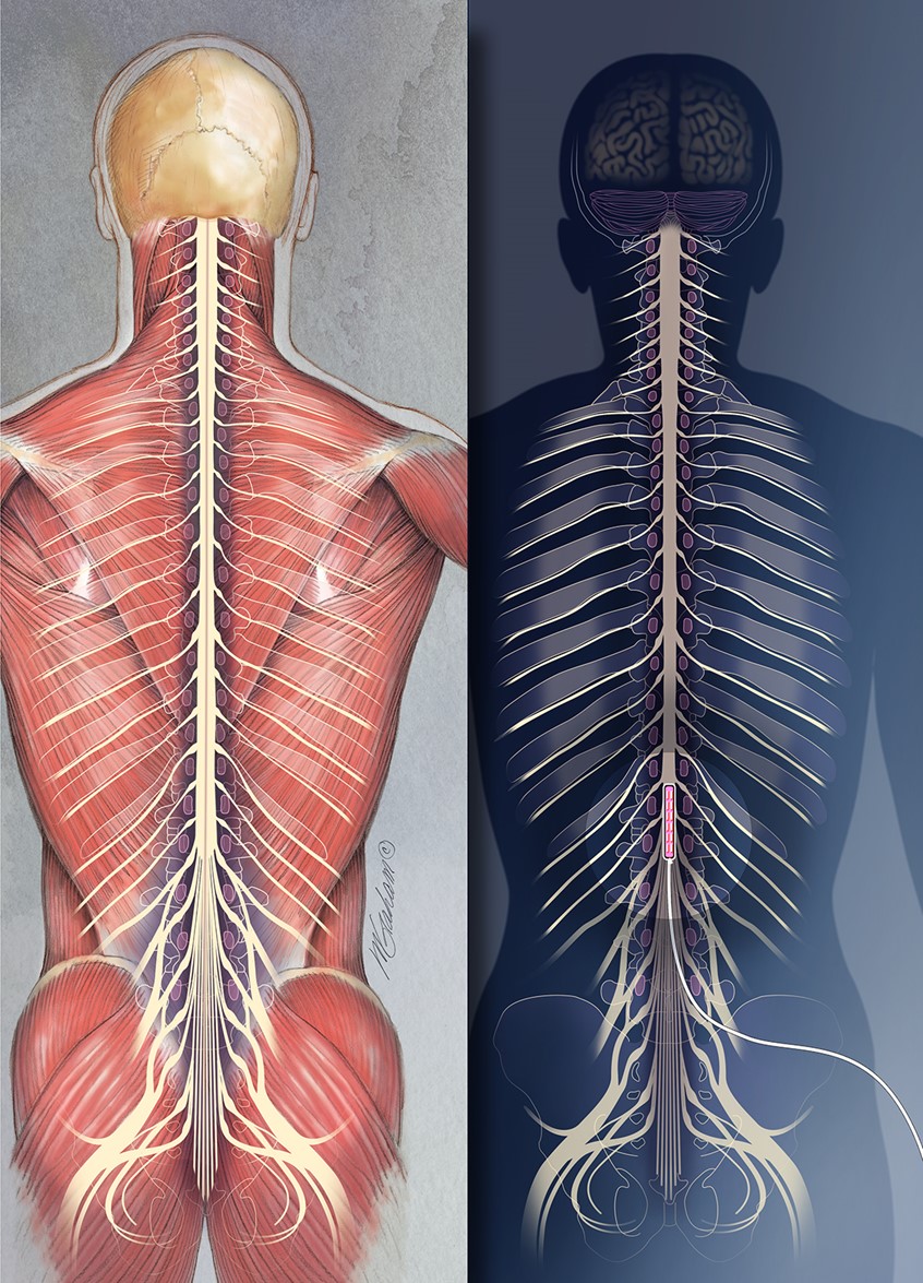 illustration of This illustration incorporates 2 different presentations of the spinal cord. The image on the left includes the musculature and the image on the right places a stimulating paddle on the cord.