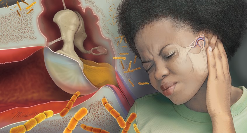 illustration of Woman has her hand held up to her ear indicating pain in her ear. Various causes of ear pain are illustrated; otitis external, otitis media. TMJ conditions. Bacteria are seen cascading across the composition.